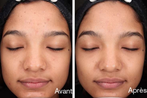 Un produit réellement efficace contre l’acné 