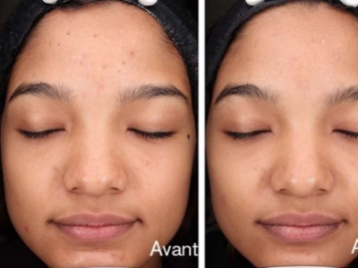 Un produit réellement efficace contre l’acné 